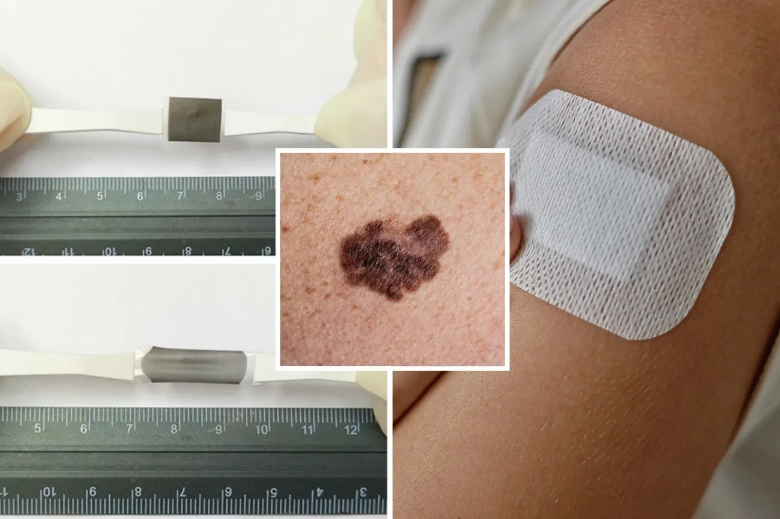 Desarrollan un parche para eliminar melanomas sin cirugía