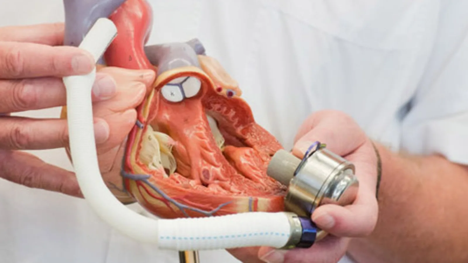México realiza primer implante de corazón artificial en medicina privada