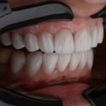 bioengineered-tooth-implants-mimic-real-sensory-feedback