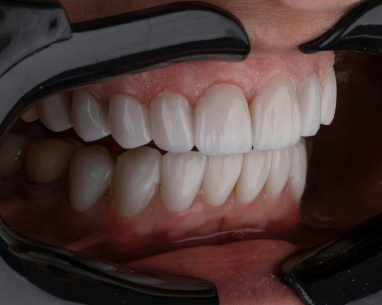 bioengineered-tooth-implants-mimic-real-sensory-feedback