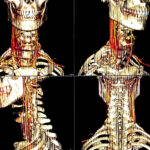 Suggestive,Of,Neck,Ct,Scan,Seen,Right,Side,Problem.,3d