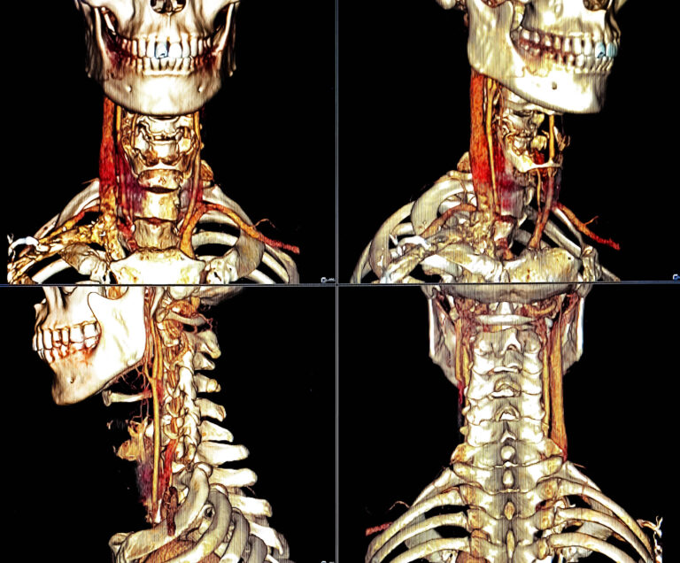 Suggestive,Of,Neck,Ct,Scan,Seen,Right,Side,Problem.,3d