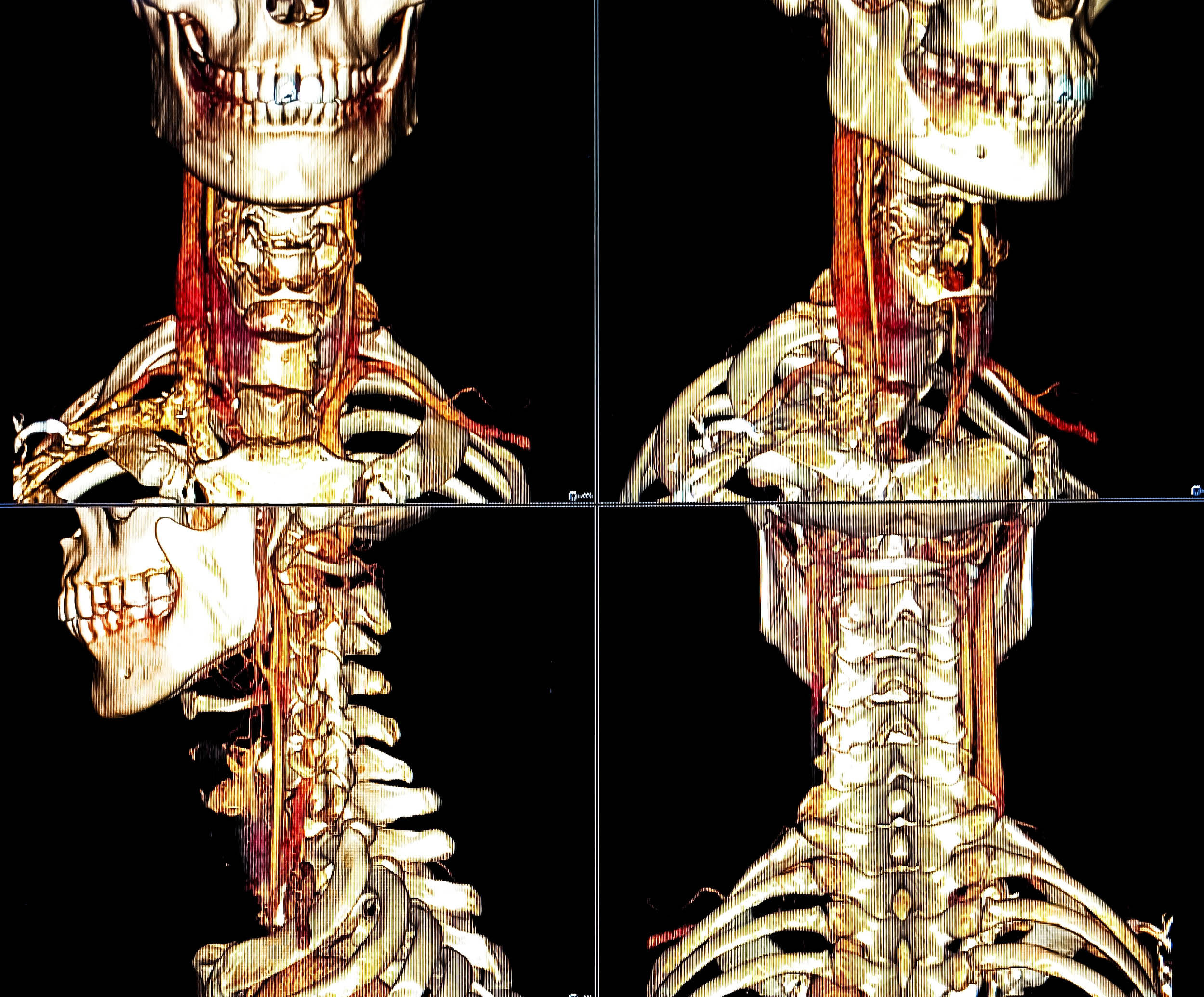 Cervical Artery Dissection: A Rising Stroke Threat