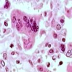 measles-outbreak-declared-in-grand-traverse-county