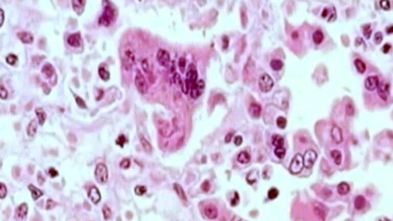 measles-outbreak-declared-in-grand-traverse-county