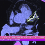 zero-coronary-artery-calcium-score-linked-to-lower-heart-risks