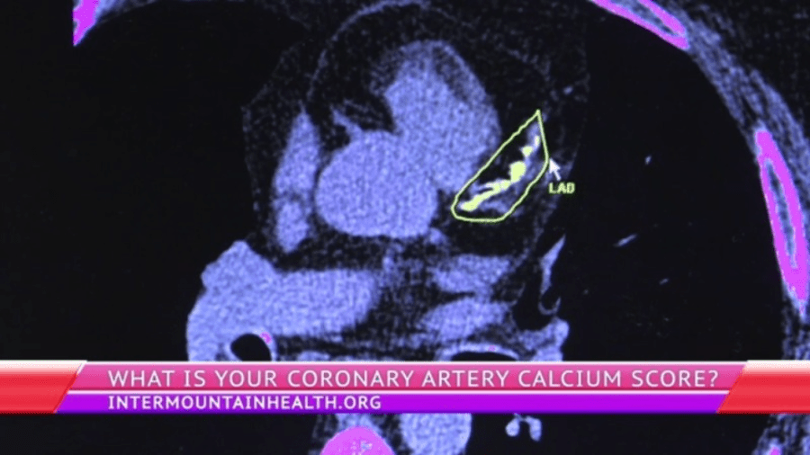 zero-coronary-artery-calcium-score-linked-to-lower-heart-risks