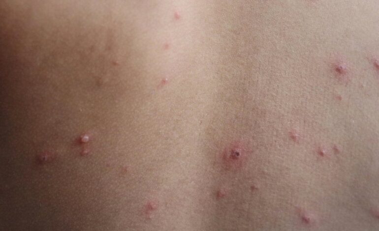 Wisconsin Health Officials Warn of Measles Exposure at Travel Stops