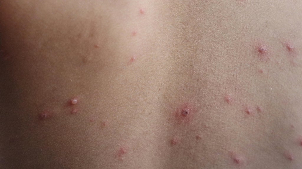 Wisconsin Health Officials Warn of Measles Exposure at Travel Stops