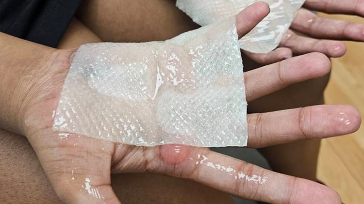 Indiana School Investigates After Students Suffer Severe Burns