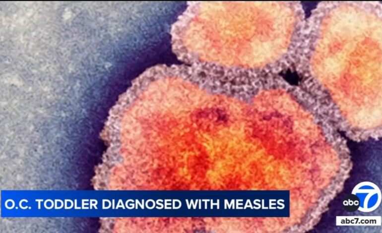 Orange County Toddler Diagnosed with Measles, Virus Contained