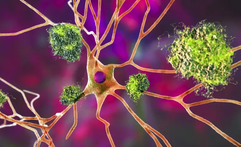 Alzheimer’s Protein Boosts Immune Cells, Reduces Cancer Risk