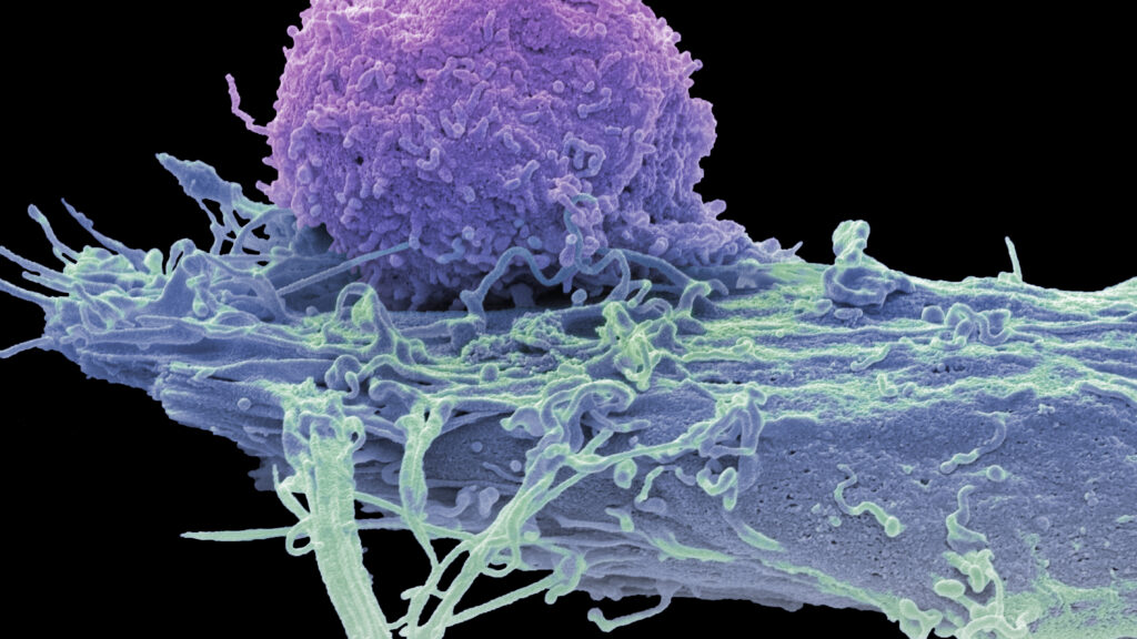 CAR-T Therapies Show Promise in Treating Autoimmune Disorders