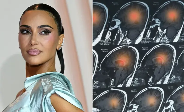 Kim Kardashian Reveals Brain Aneurysm Diagnosis, Experts Weigh In