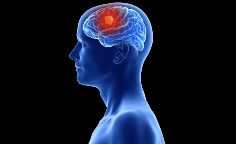 Scientists Uncover How Glioblastoma Attacks Skull, Complicates Treatment