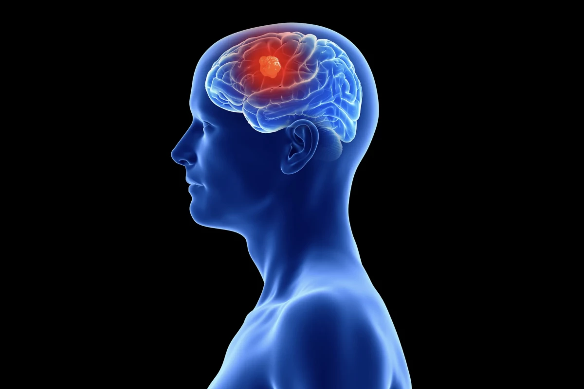 Scientists Uncover How Glioblastoma Attacks Skull, Complicates Treatment