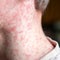 Urgent: 153 Unvaccinated SC Students Quarantined After Measles Exposure