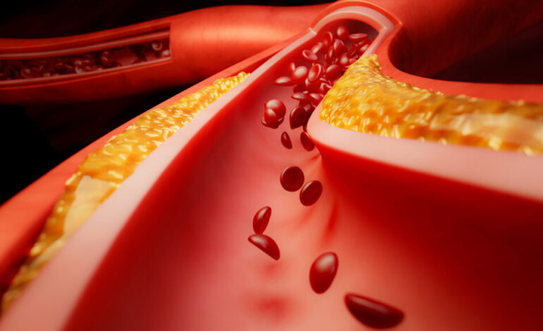 Bristol Myers Squibb and J&J’s Milvexian Fails Key Trial for Blood Thinner