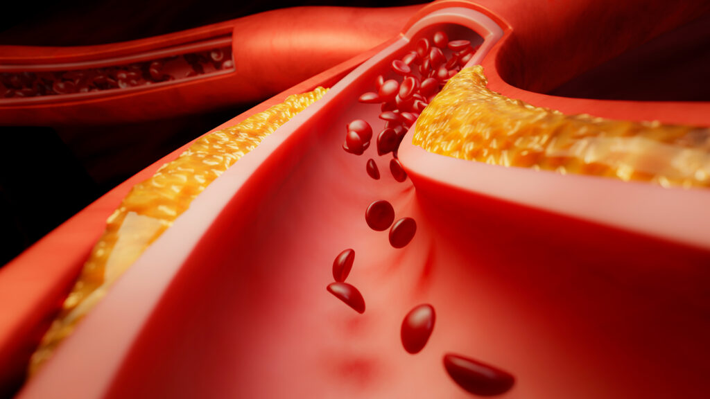 Bristol Myers Squibb and Johnson & Johnson’s Blood Thinner Fails Key Trial