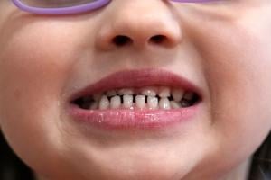 FDA Limits Use of Fluoride Supplements for Children’s Dental Care