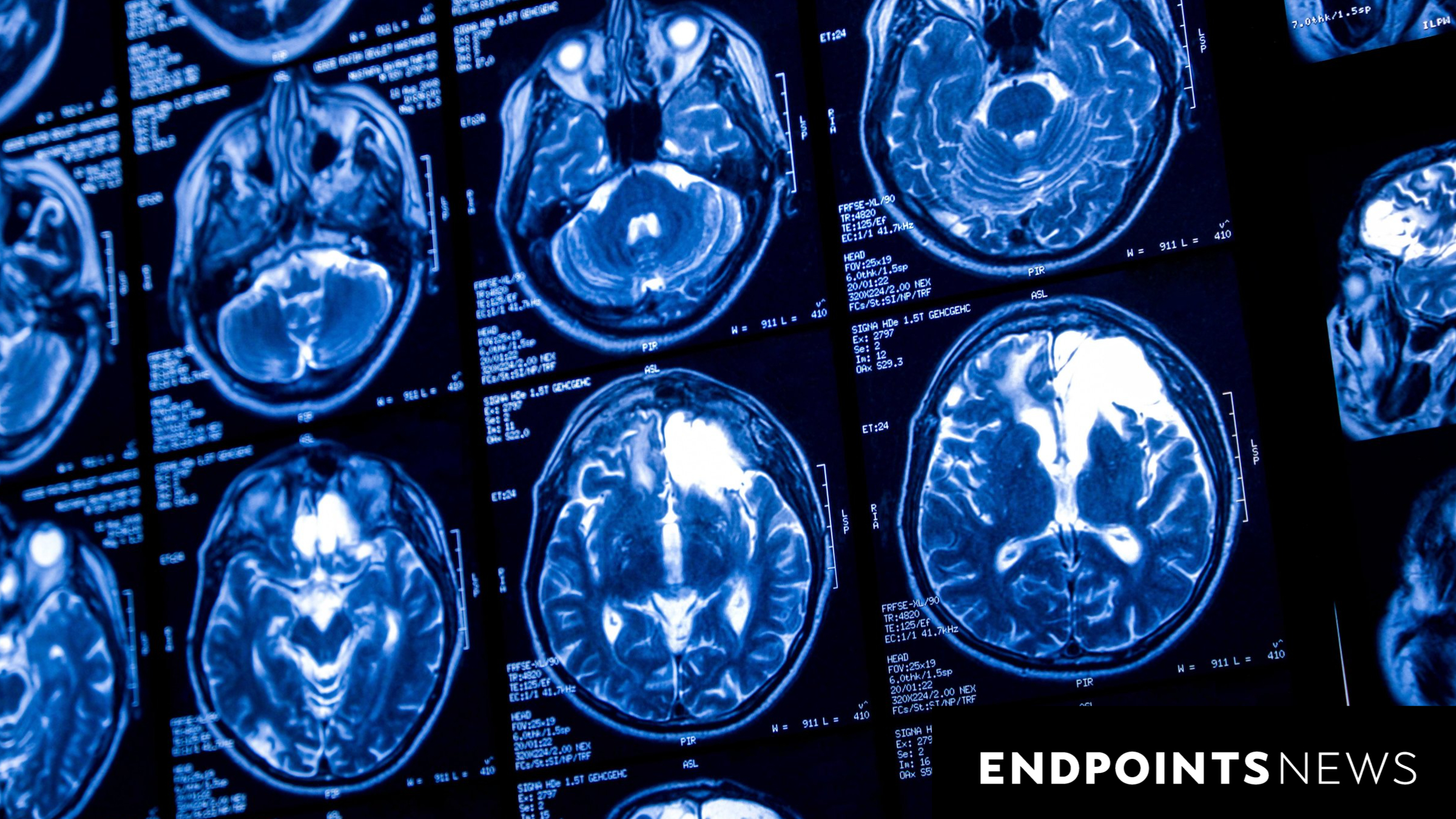 Nuvation Bio Withdraws from Brain Cancer Drug Trial Plans