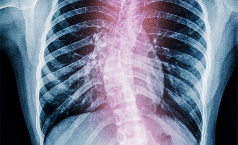 Early Detection of Scoliosis: Symptoms and Effective Treatments