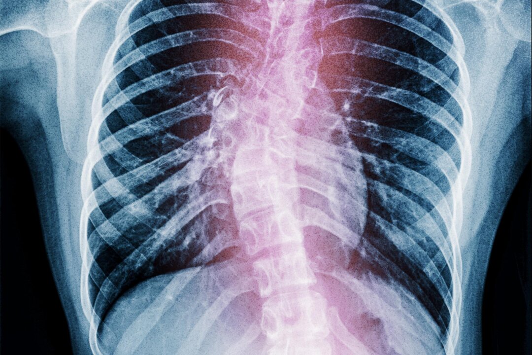 Early Detection of Scoliosis: Symptoms and Effective Treatments